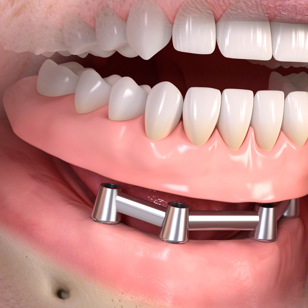Removable_denture_with_bar_03
